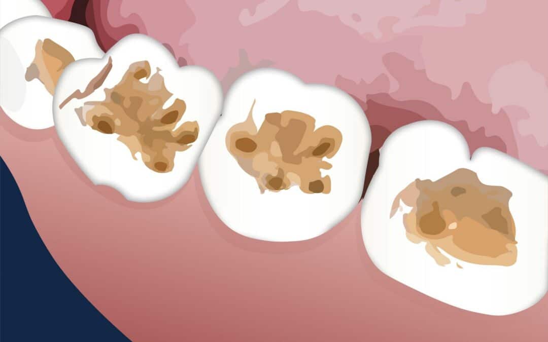 tooth enamel repair, dentist in Lexington KY